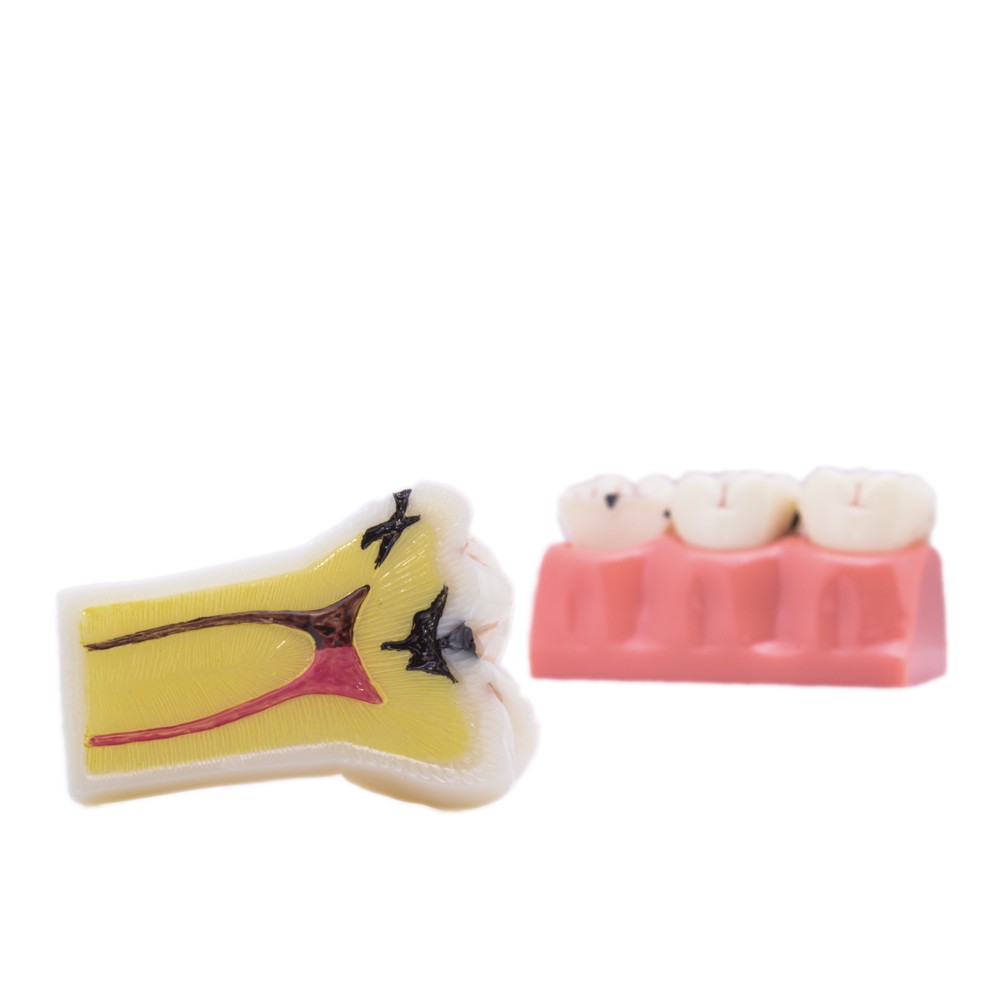 Bader Removable Caries Model