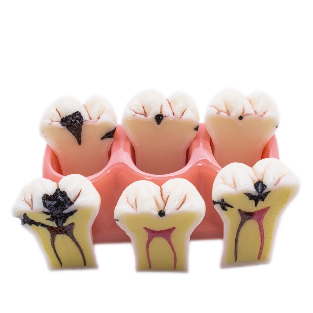 Bader Removable Caries Model