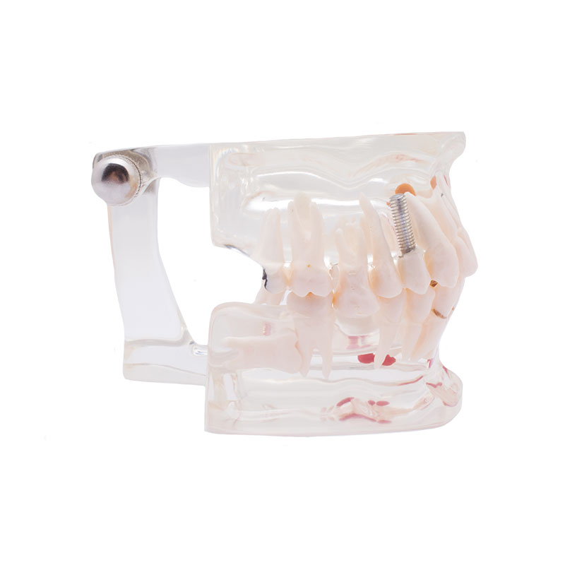 Bader Transparent Model with Implant