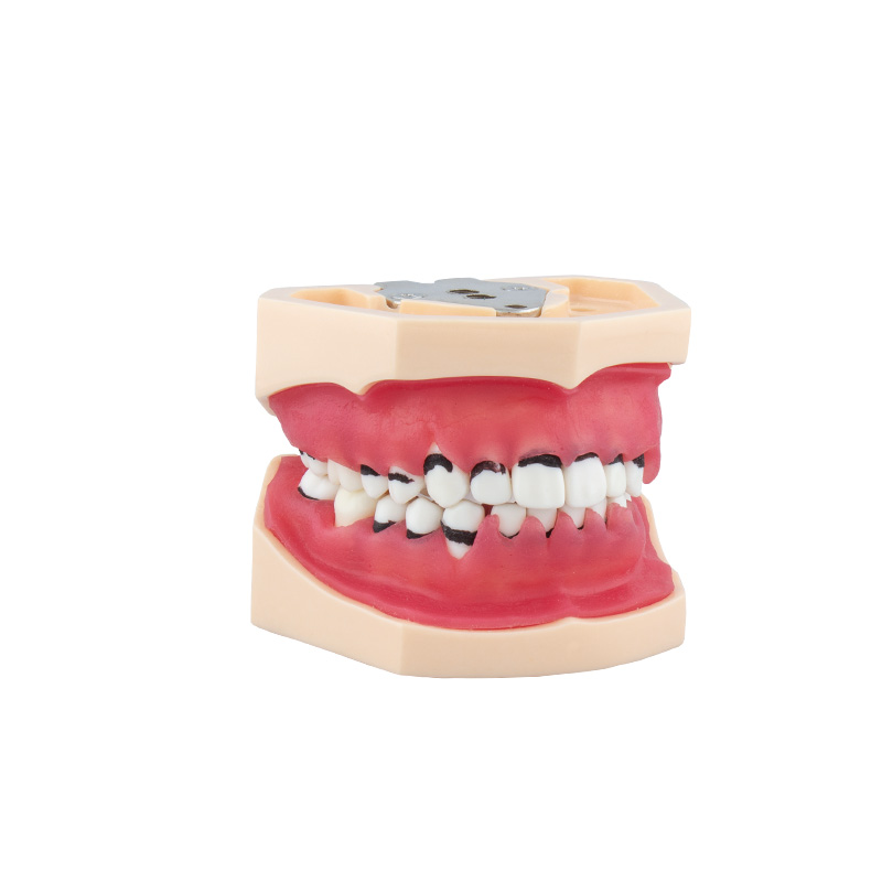 Bader Complete Periodontitis Model