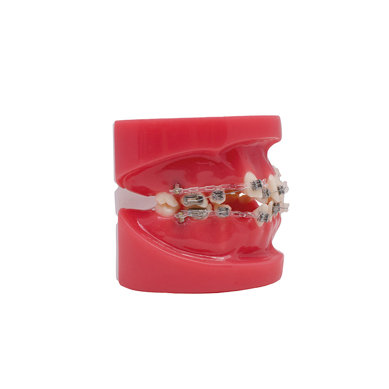 Model of Metallic and Sapphire Bracket Bader