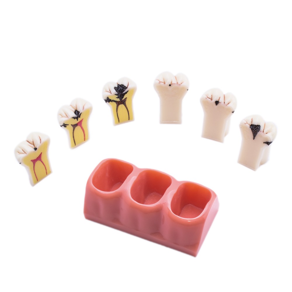 Bader Removable Caries Model
