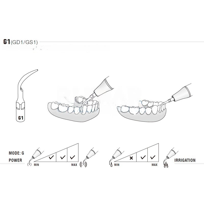 Pack of 5 Woodpecker GD1 ultrasound tips compatible Satelec | Prophylaxis