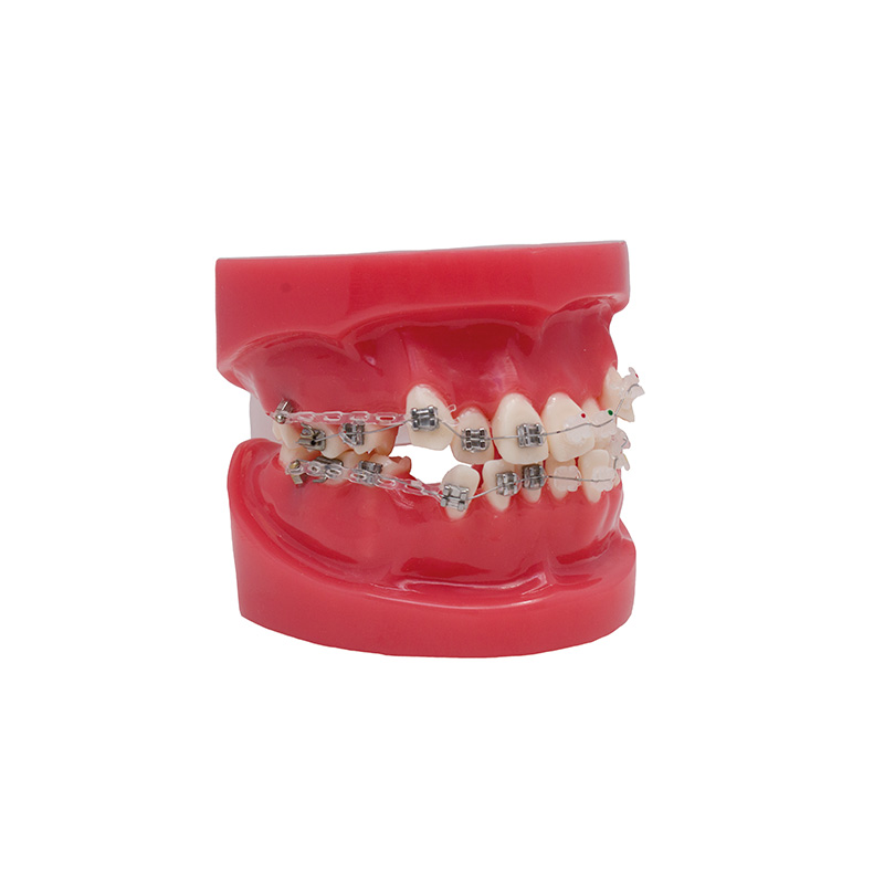 Model of Metallic and Sapphire Bracket Bader