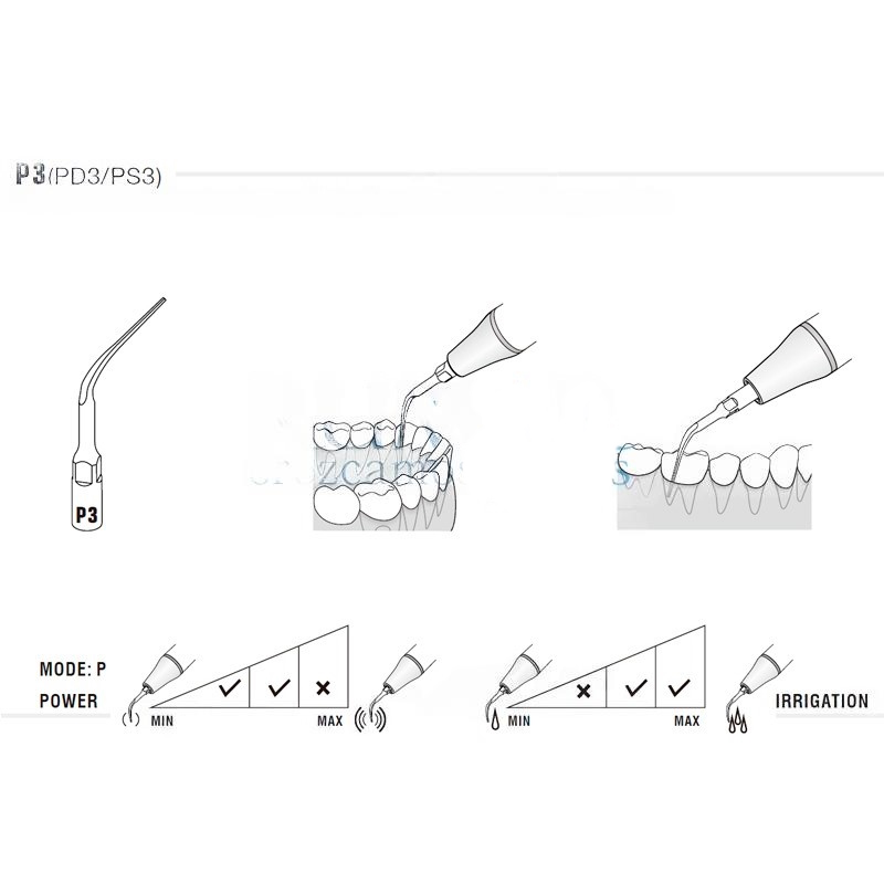 Woodpecker PD3 ultrasonic tip compatible with Satelec | Perio
