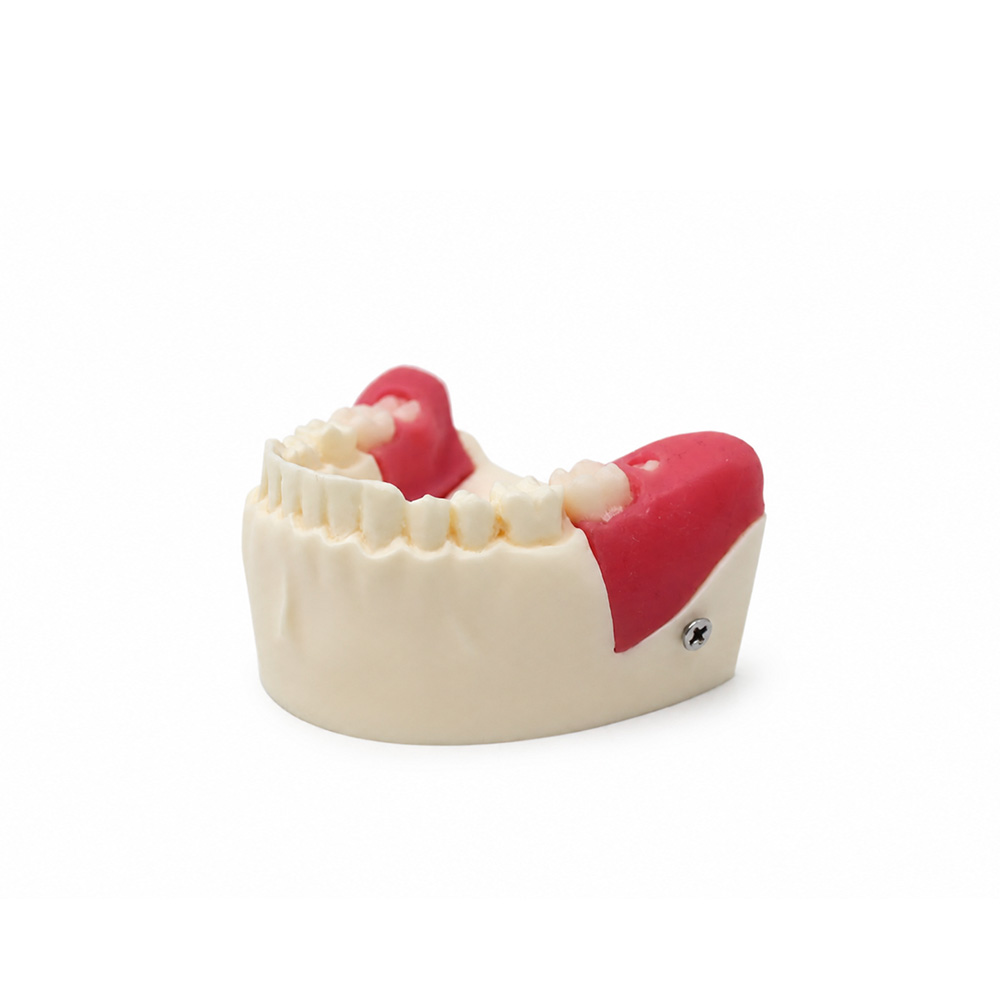 Model of Extraction of Retained and Semi-Retained Teeth Bader
