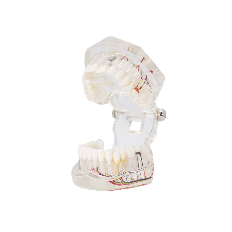Bader implant model with nerve