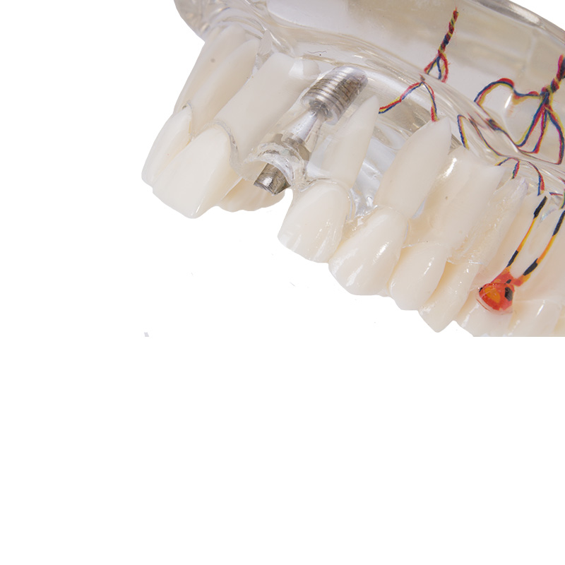 Bader implant model with nerve