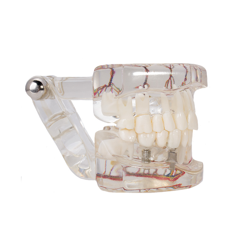 Bader implant model with nerve