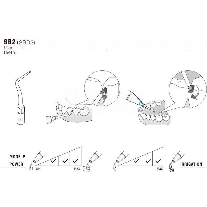 Woodpecker SB2 ultrasonic tip compatible with EMS | Cavities, Diamond