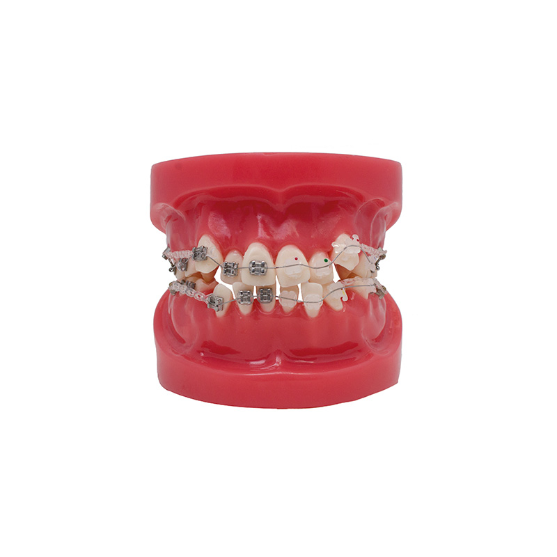 Model of Metallic and Sapphire Bracket Bader