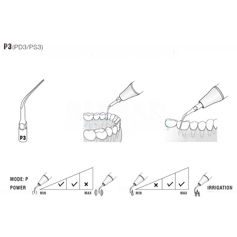 Woodpecker P3T ultrasonic tip compatible with EMS | Perio, Titanium Treatment