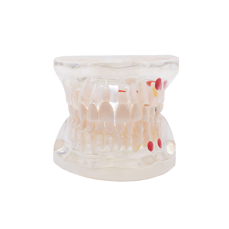 Bader transparent caries model