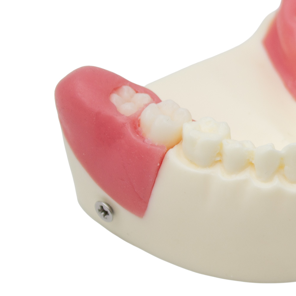 Model of Extraction of Retained and Semi-Retained Teeth Bader