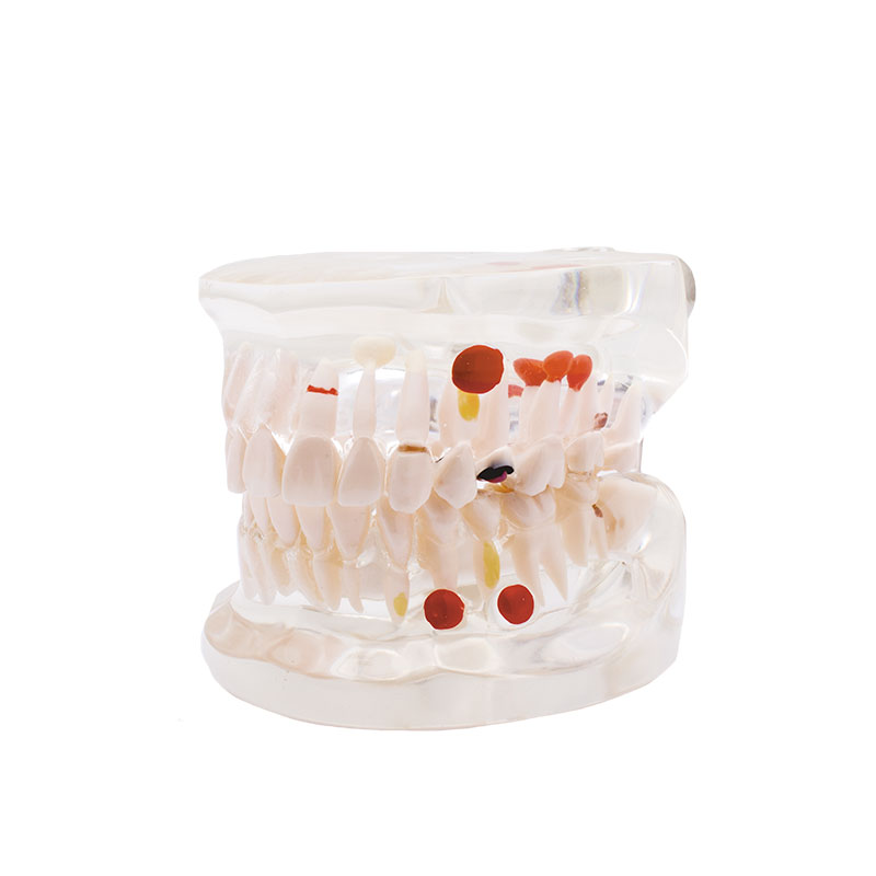 Bader transparent caries model