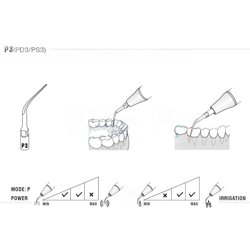 Woodpecker PD3T ultrasonic tip compatible with Satelec | Perio, Titanium Treatment