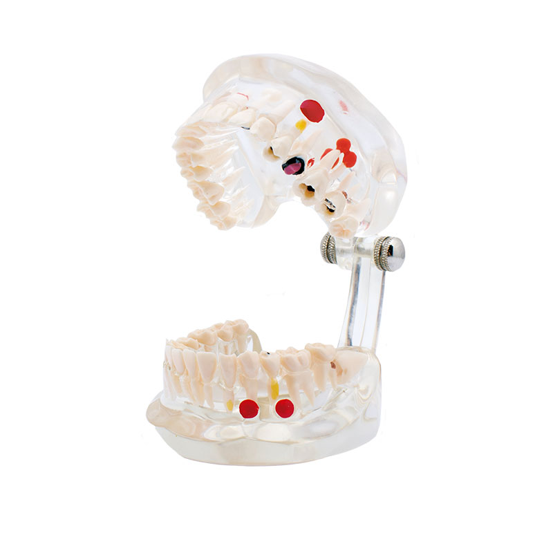 Bader transparent caries model
