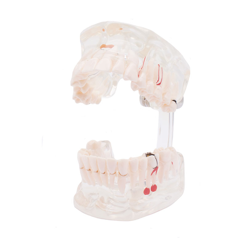 Bader Transparent Model with Implant