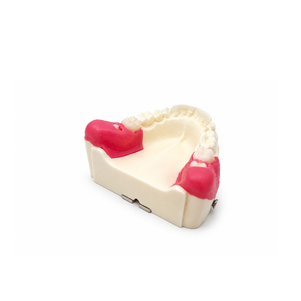 Model of Extraction of Retained and Semi-Retained Teeth Bader