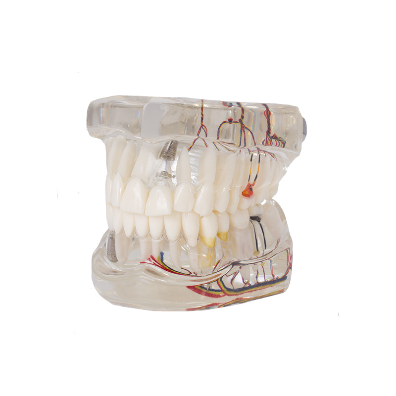 Bader implant model with nerve