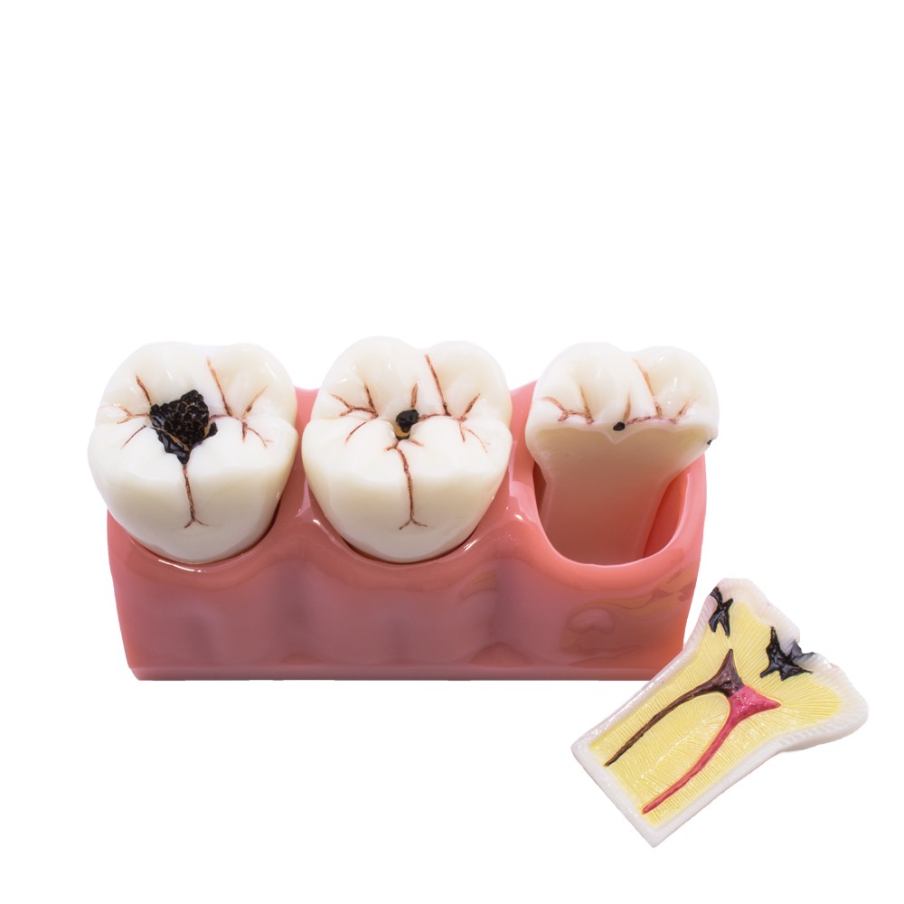 Bader Removable Caries Model