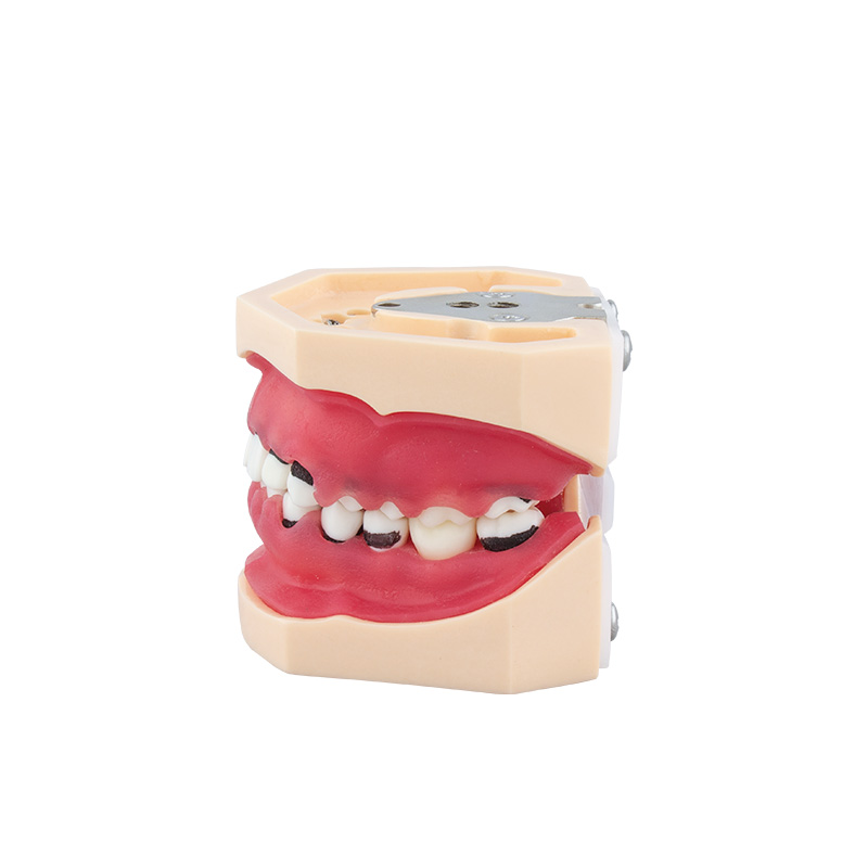 Bader Complete Periodontitis Model