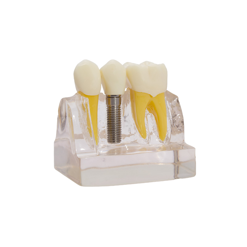 Bader implant demonstration model