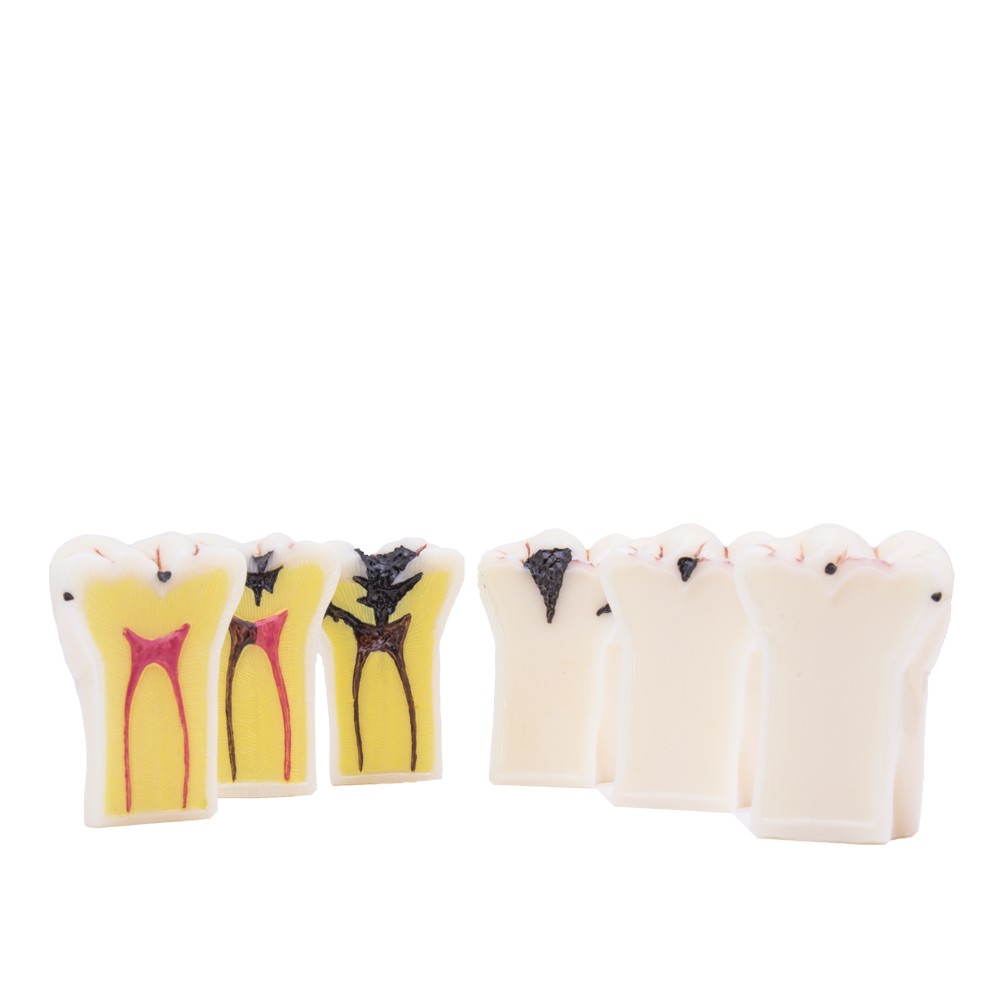 Bader Removable Caries Model