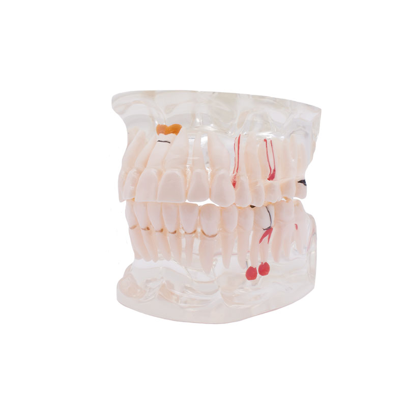 Bader Transparent Model with Implant
