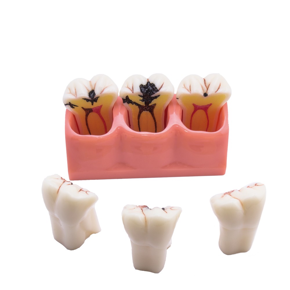 Bader Removable Caries Model